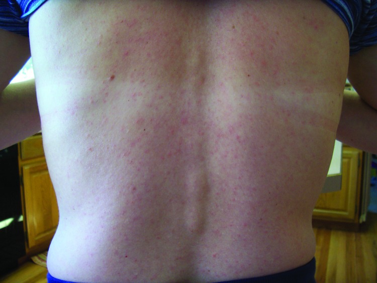 Maculopapular rash on patient infected with Zika virus[4]