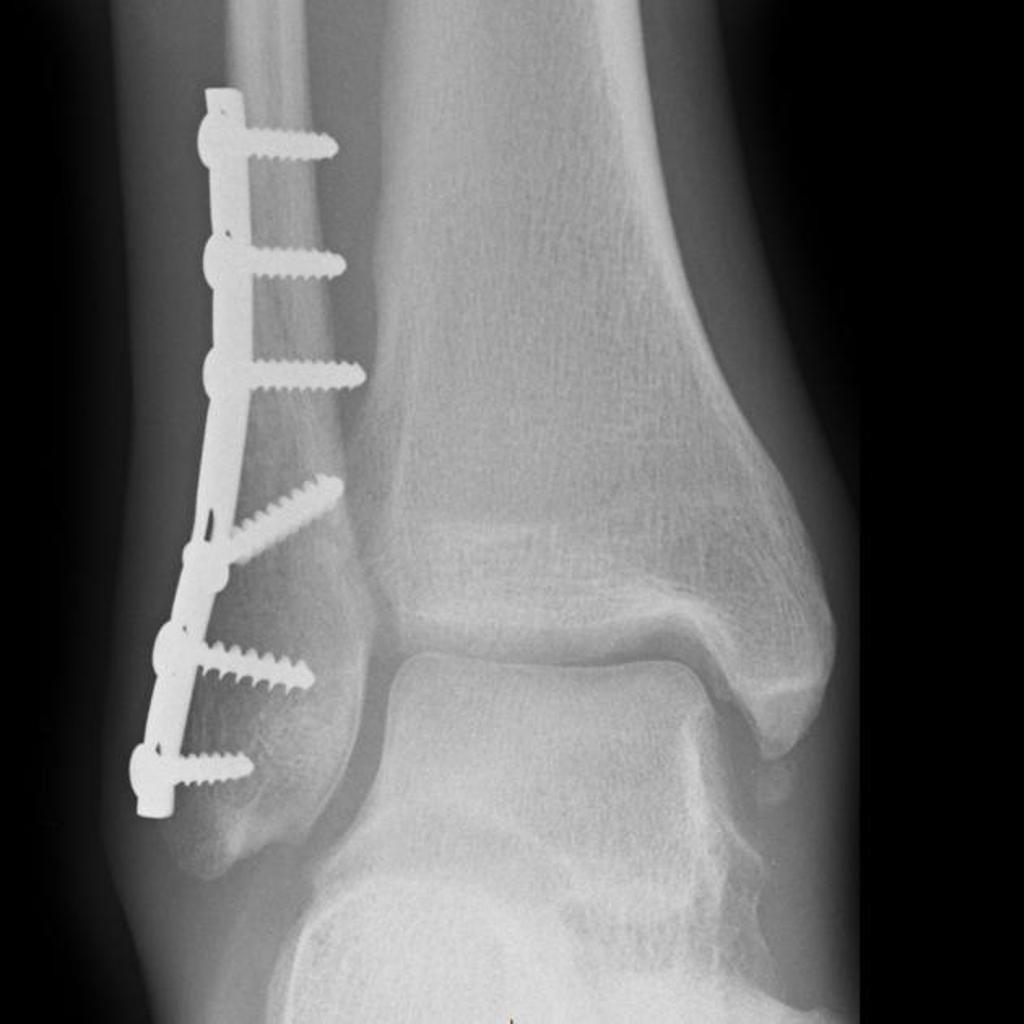 File:Ankle-fracture-weber-b-8 (1).jpg