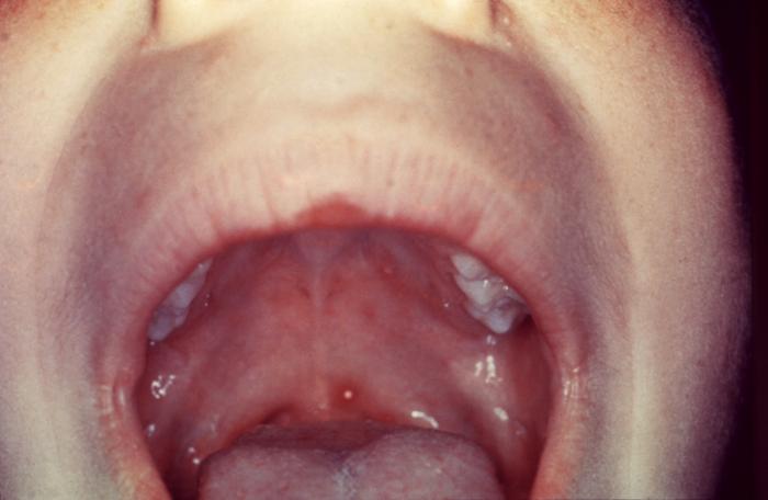 Patient developed palatal mucosal lesions due to chickenpox. From Public Health Image Library (PHIL). [24]