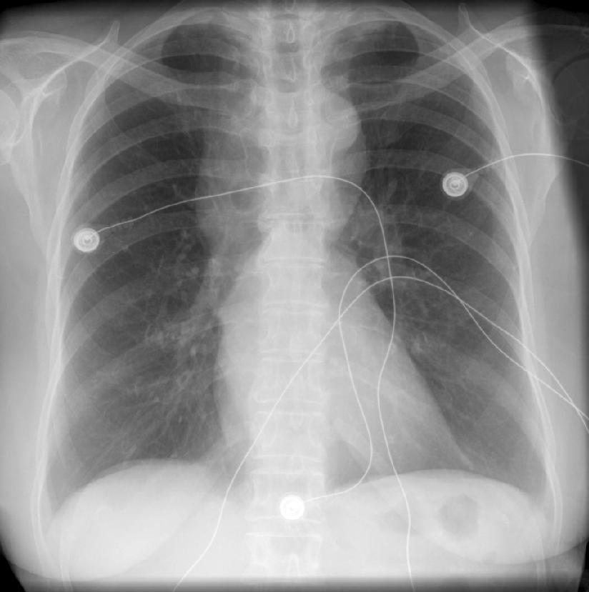 A female patient presented with noisy breathing. The PA chest x-ray shows an abnormal superior mediastinum and cardiac contour. There is a curved bulge to the right of trachea and above the right main bronchus. There is the suggestion of a rounded density to the right of the trachea at T4 level. There is what looks like a left aortic knuckle, but it is somewhat superiorly positioned. There is an abnormal sharp angle in the left mediastinal contour, in the region of the main pulmonary artery. The descending aorta shadow is absent on the left below this level, but there is a double shadow on the right.