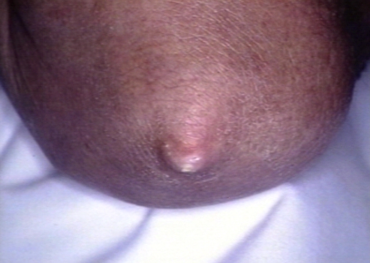 Skin: Scleroderma in crest syndrome; calcinosis at elbow