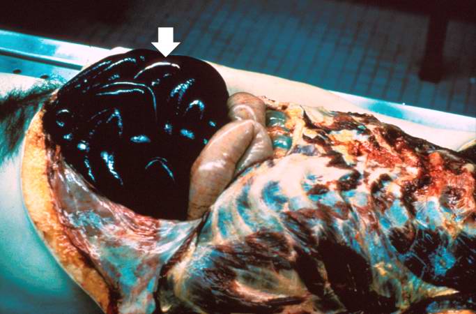 This is a gross photograph of an opened abdomen at autopsy demonstrating loops of infarcted bowel (arrow). Vascular occlusion can lead to ischemic necrosis of the bowel. In this case, a section of bowel herniated through a fibrous connective tissue band and was strangulated, leading to ischemic necrosis.