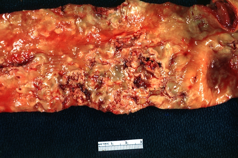 Atherosclerosis: Gross, very good example of calcified and ulcerated atheromatous plaques in aorta