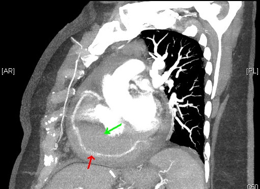 CTA sagittal section showing cardiac mass (green arrow) encasing the right coronary artery (red arrow).
