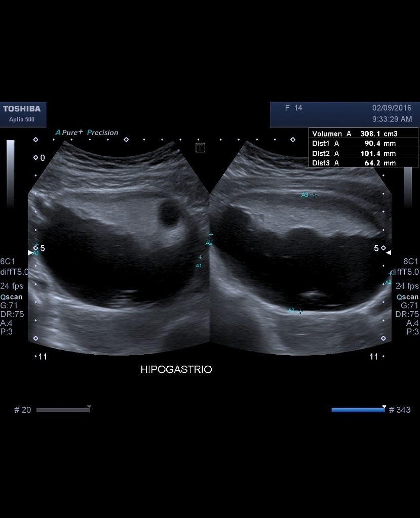 File:Mature-cystic-ovarian-teratoma-6 (1).jpg