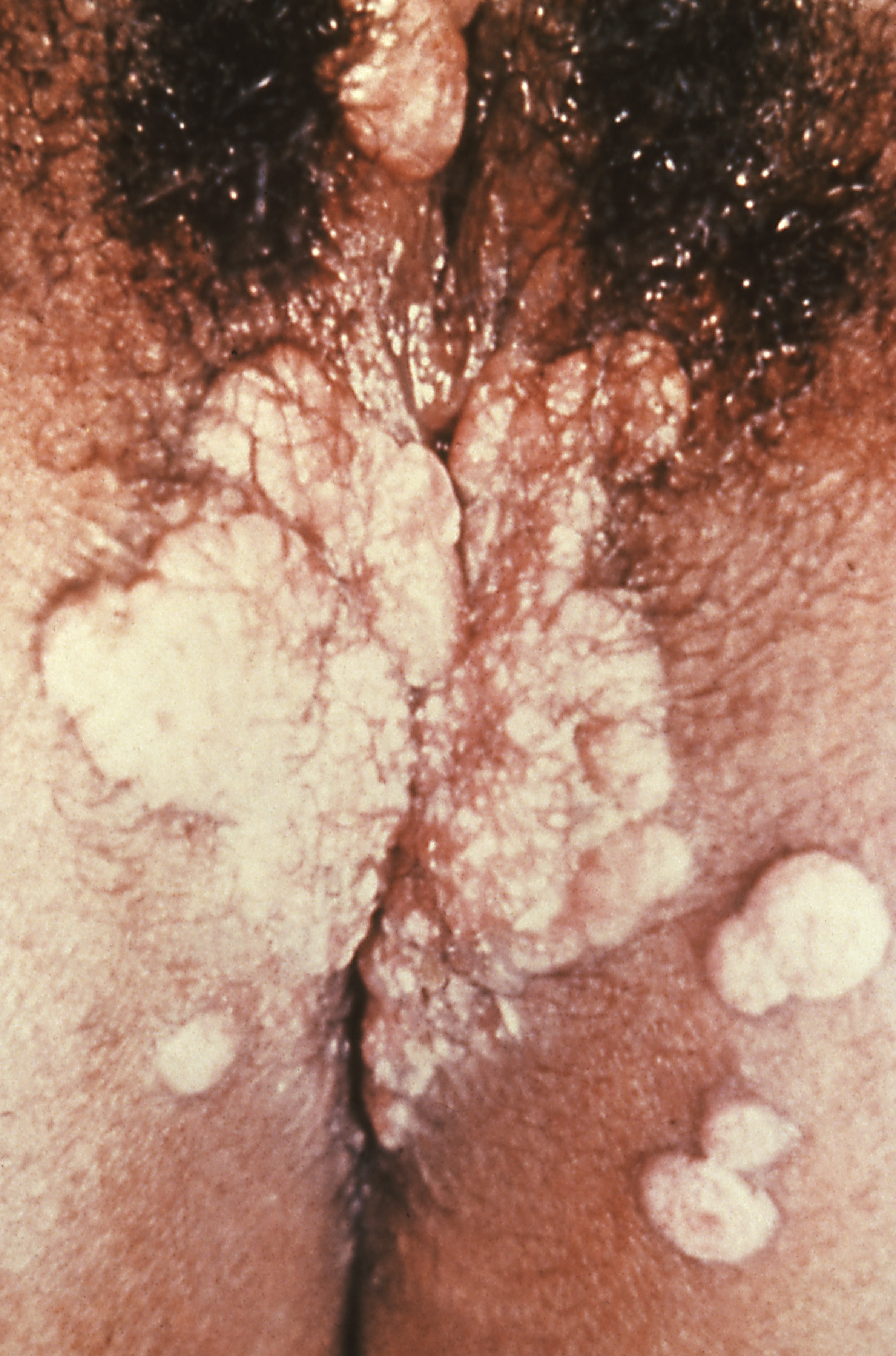 Secondary syphilis manifested perineal condylomata lata lesions, which presented as gray, raised papules that sometimes appear on the vulva or near the anus, or in any other warm intertriginous region.