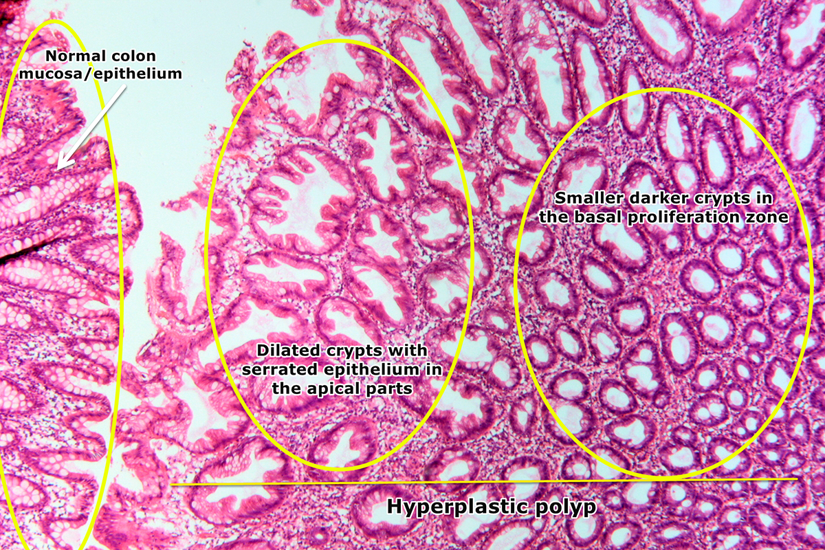 File:Hyperplastic polyp of the colon, HE.png