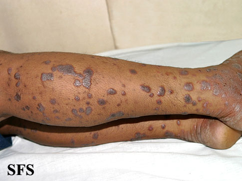Lichen planus. Adapted from Dermatology Atlas.[1]