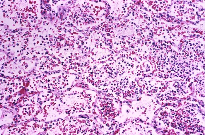 Photomicrograph depicting the histopathologic changes in lung tissue in a case of fatal human plague pneumonia; Mag. 160X Adapted from Public Health Image Library (PHIL), Centers for Disease Control and Prevention.[19]