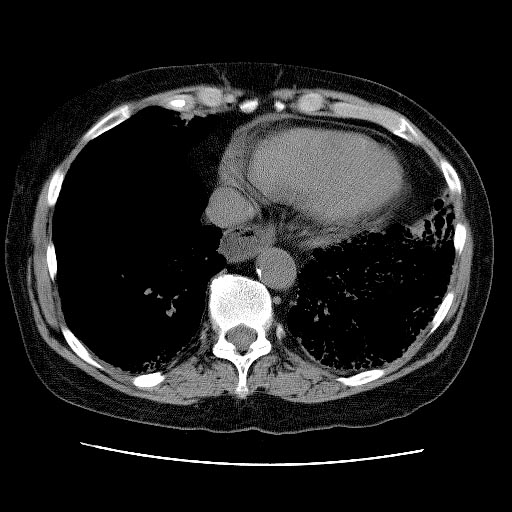 CT: Lung involvement in Scleroderma