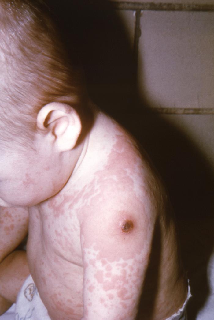Recipient of a smallpox vaccination in his left shoulder, who subsequently developed a generalized, full-body rash, due to an allergic reaction to the vaccination.Adapted from Public Health Image Library (PHIL), Centers for Disease Control and Prevention.[3]