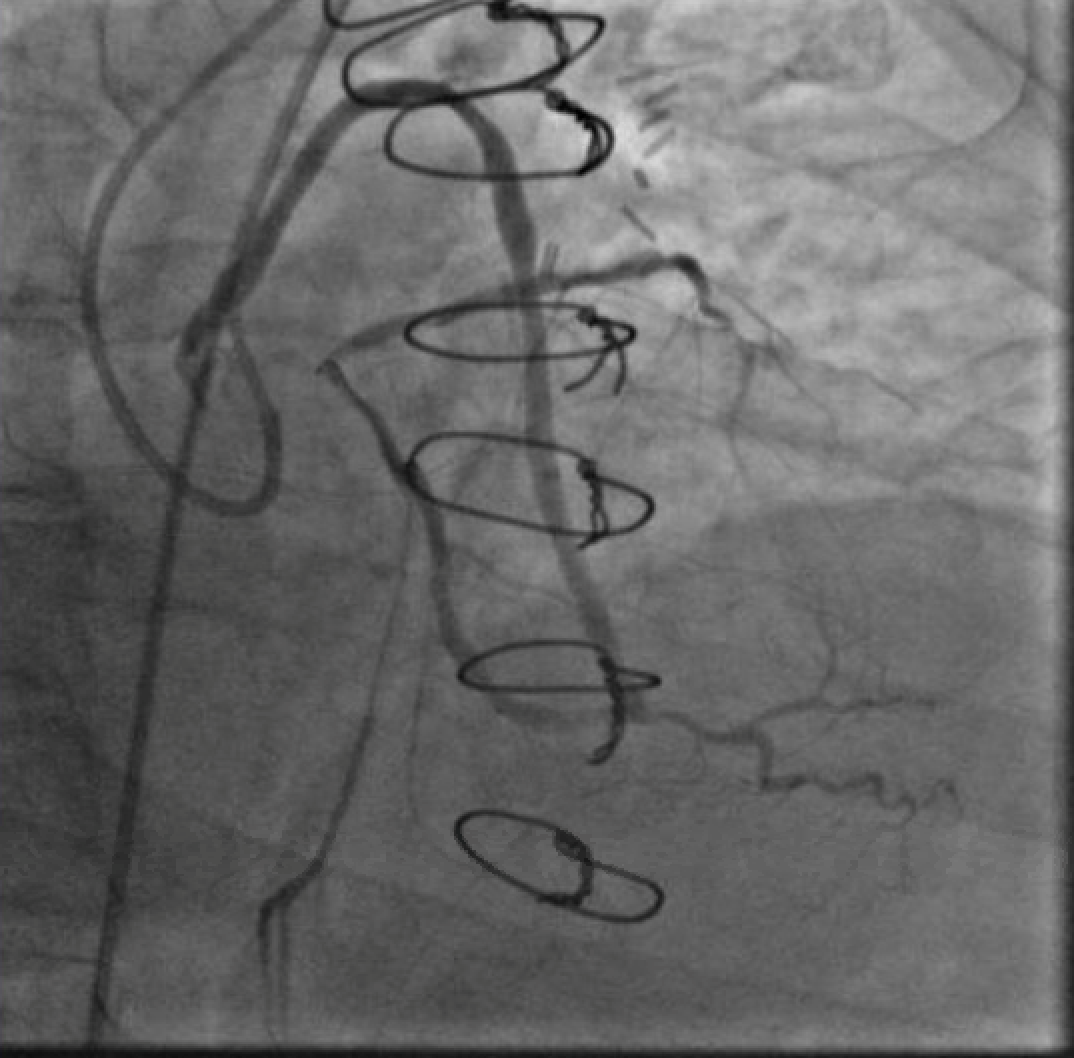 Figure 2. A wire in the ostial circumflex supported by an OTW balloon and a guide extension catheter. Note the kink just proximal to the anatamosis of the SVG to the OM and poor flow in the distal LAD.