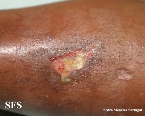 . Adapted from Dermatology Atlas.[1]