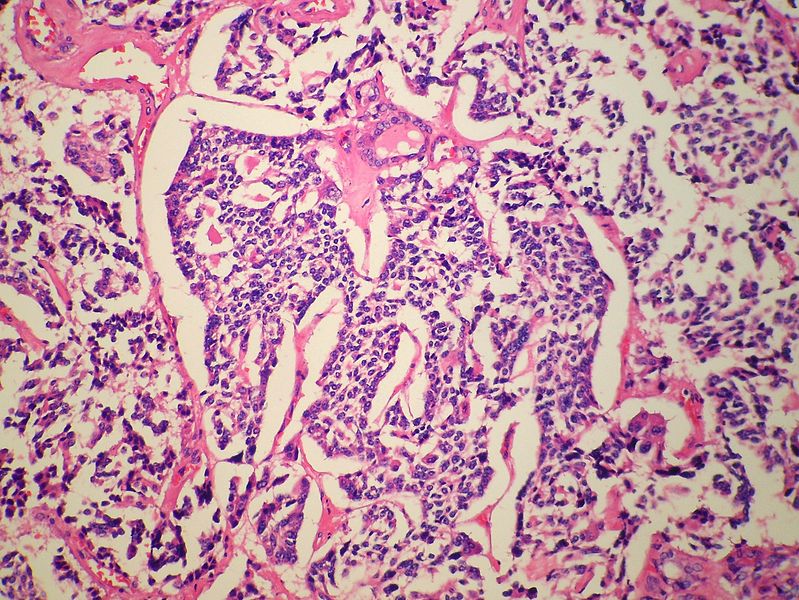 Medullary thyroid carcinoma spindle cell