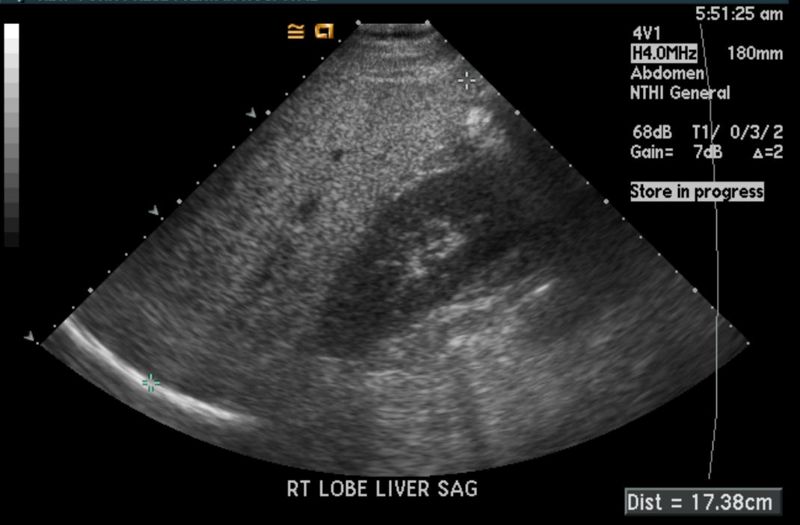 File:Fatty infiltration of liver ultrasound 102.jpg