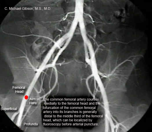 The bifurcation of the femoral artery generally lies distal to the middle third of the femoral head, and the site of arterial puncture should lie above this (click to enlarge)