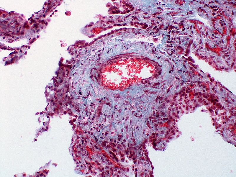 Marked adventitial thickening. Masson trichrome stain.