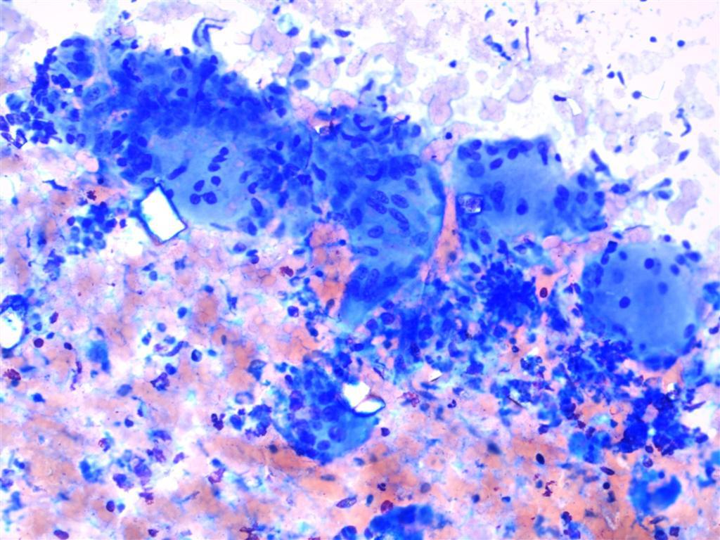 FNA smear of De Quervain's thyroiditis; Inflammatory rich smear with giant cells and probable granulomata. (Case courtesy of Dr Andrew Ryan, <a href="https://radiopaedia.org/">Radiopaedia.org</a>. From the case <a href="https://radiopaedia.org/cases/17052">rID: 17052</a>)]])
