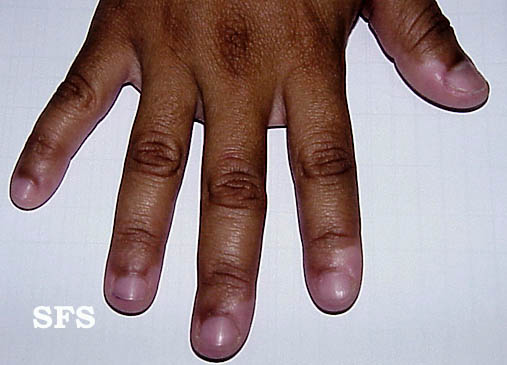 Vitiligo. Adapted from Dermatology Atlas[11]