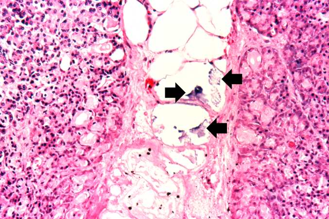 This high-power photomicrograph demonstrates fat necrosis in the interlobular spaces of the pancreas. Note the granular blue-staining calcium deposits (arrows) within the fat cells. The clear areas represent artifact caused by the "washing-out" of fat from cells during tissue processing for histology.