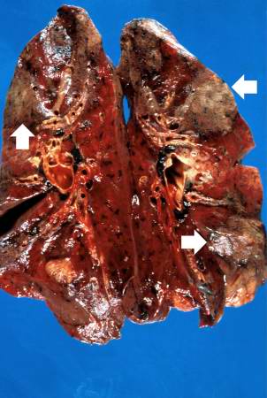 This is a gross photograph of cut sections of lung. There are several areas of fibrosis (arrows) within the lung parenchyma.