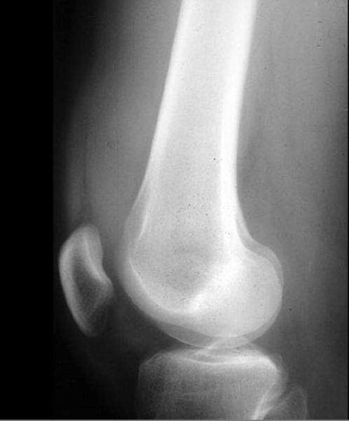 File:Segond-fracture-with-ACL-tear-002.jpg