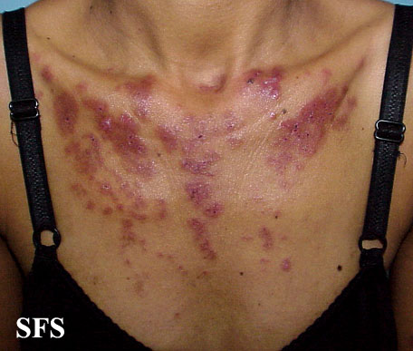 Subacute cutaneous lupus erythematosus. Adapted from Dermatology Atlas.[4]