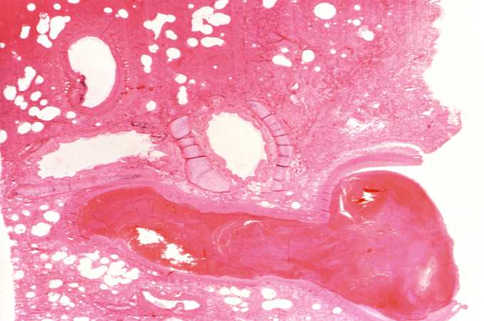 This is a low-power photomicrograph of lung. A large thrombus is lodged at this branch point in the pulmonary artery. Note the hemorrhage and congestion in the surrounding lung parenchyma.