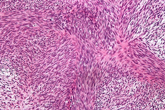 File:640px-Malignant peripheral nerve sheath tumour - high mag.jpg