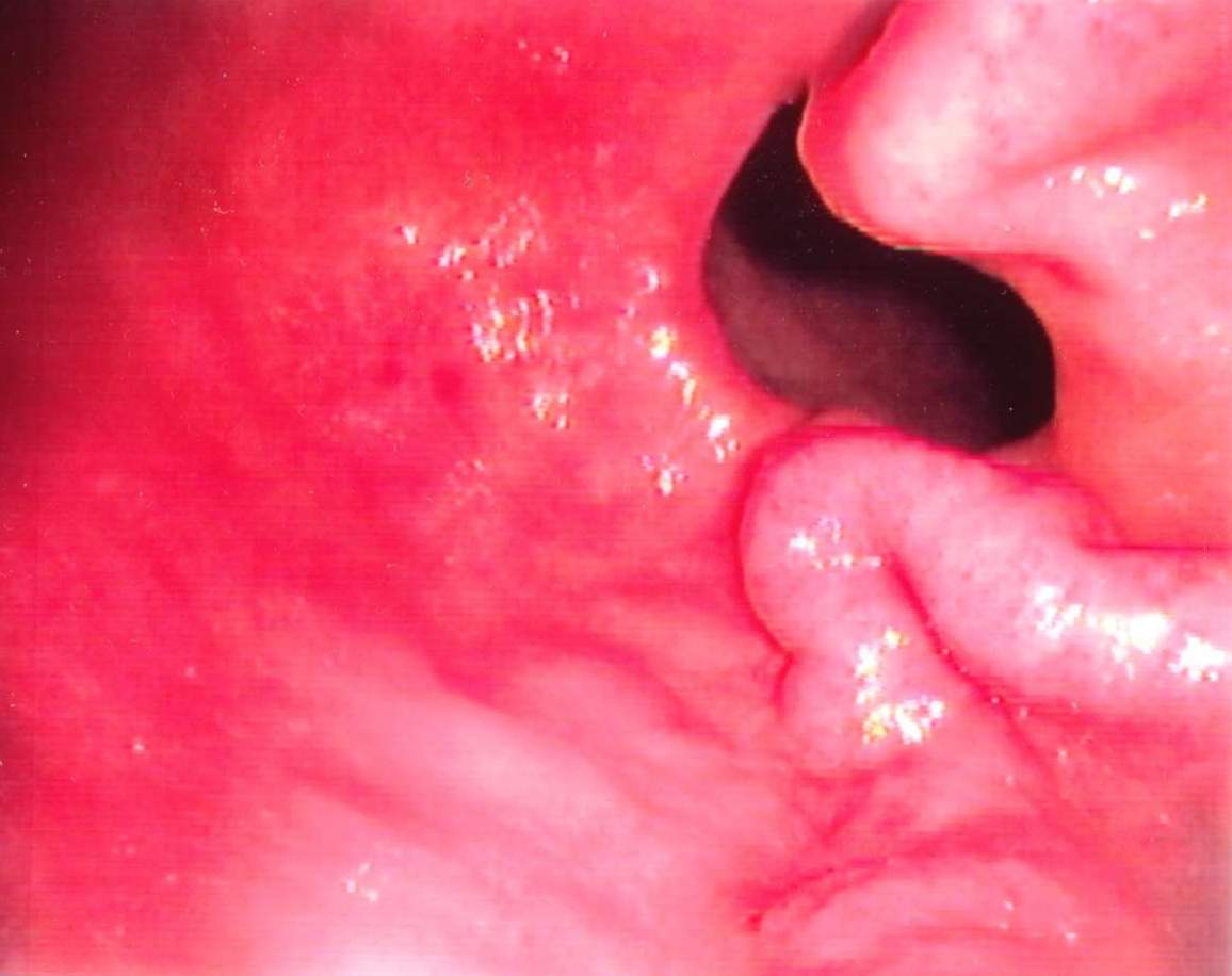 Antral varices, of Sarin classification IGV-2, an unusual class of gastric varices