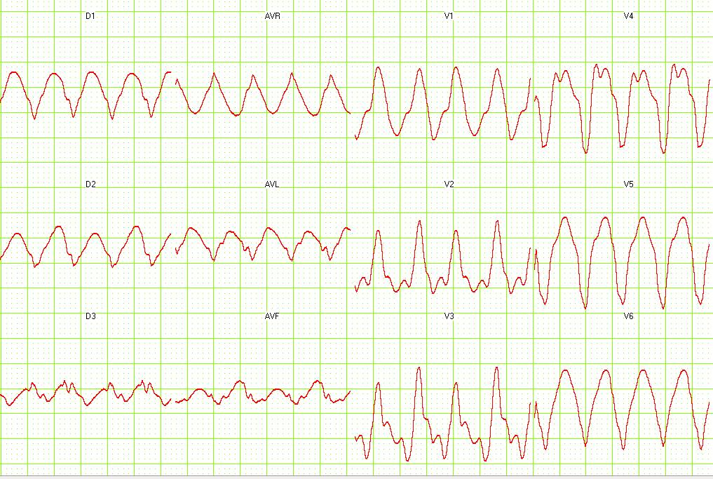 12 lead EKG: Ventricular tachycardia. Image courtesy of Dr Jose Ganseman