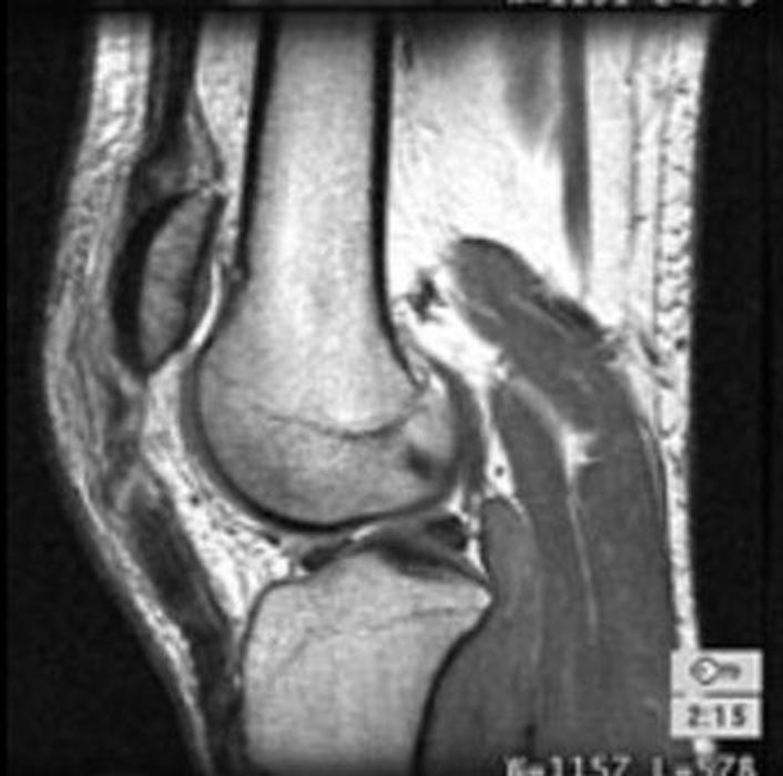 MRI: Patellar tendon rupture