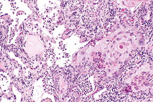 File:300px-Lung squamous carcinoma -- intermed mag.jpg