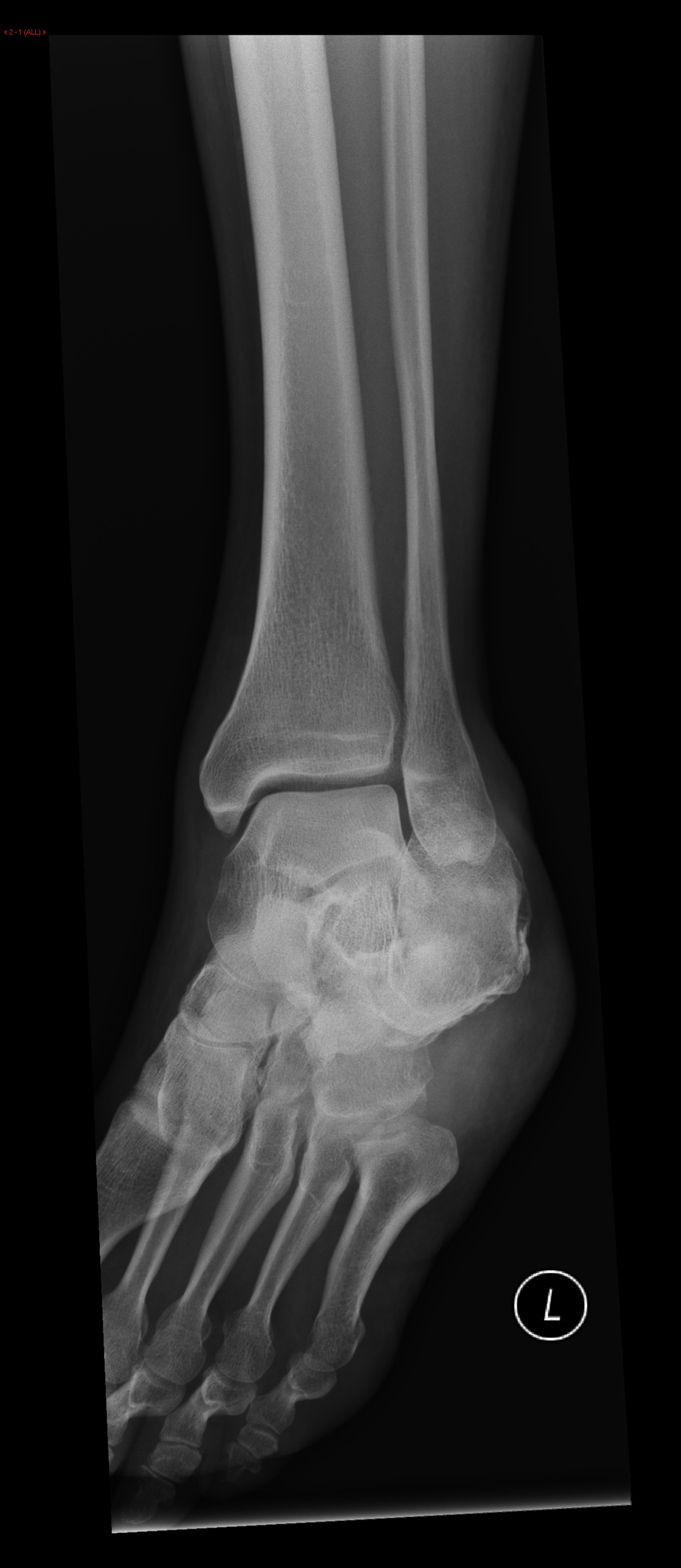 Frontal Plain films show a comminuted fracture of the left calcaneus with a flattening of Bohler's angle.