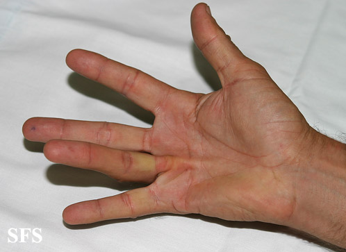 Dupuytren contracture. Adapted from Dermatology Atlas.[3]