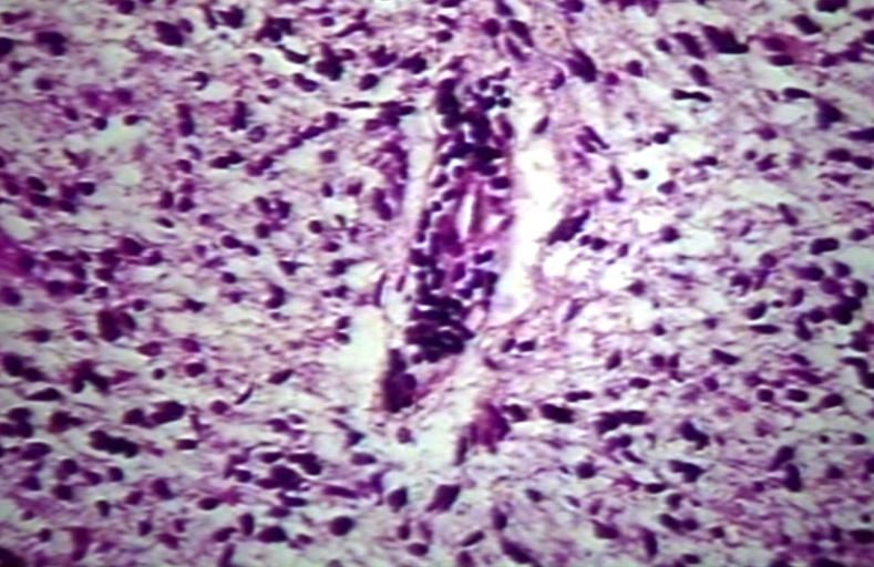 Brain: Glioblastoma multiforme; perivascular lymphocytes