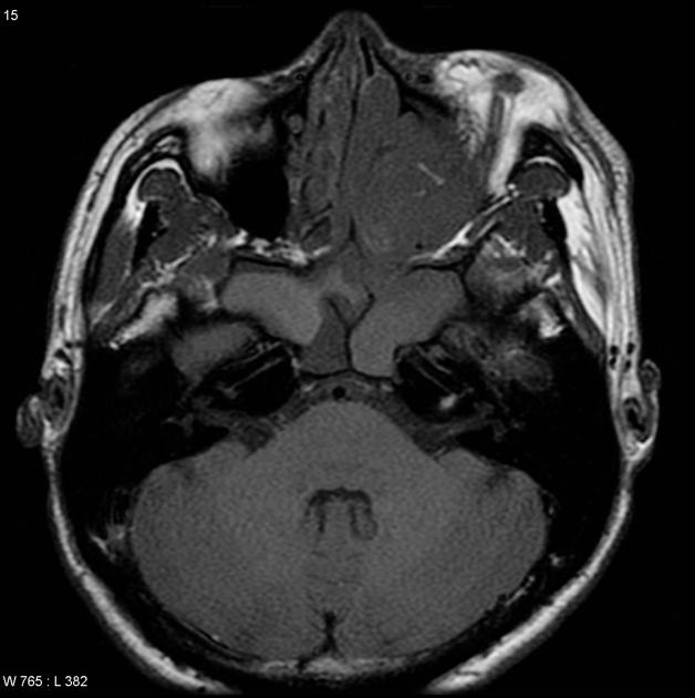 MRI showing T1 image od esthesioneuroblastoma [2]