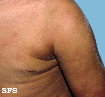 Urticaria pigmentosa. Adapted from Dermatology Atlas.[1]