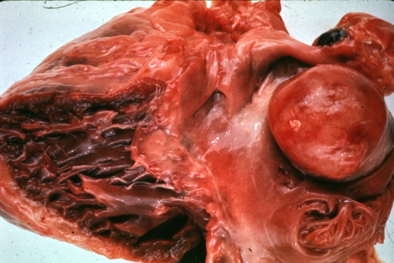 Image A HEART: Metastatic Tumor: Gross very unusual large metastatic carcinoid in right atrium