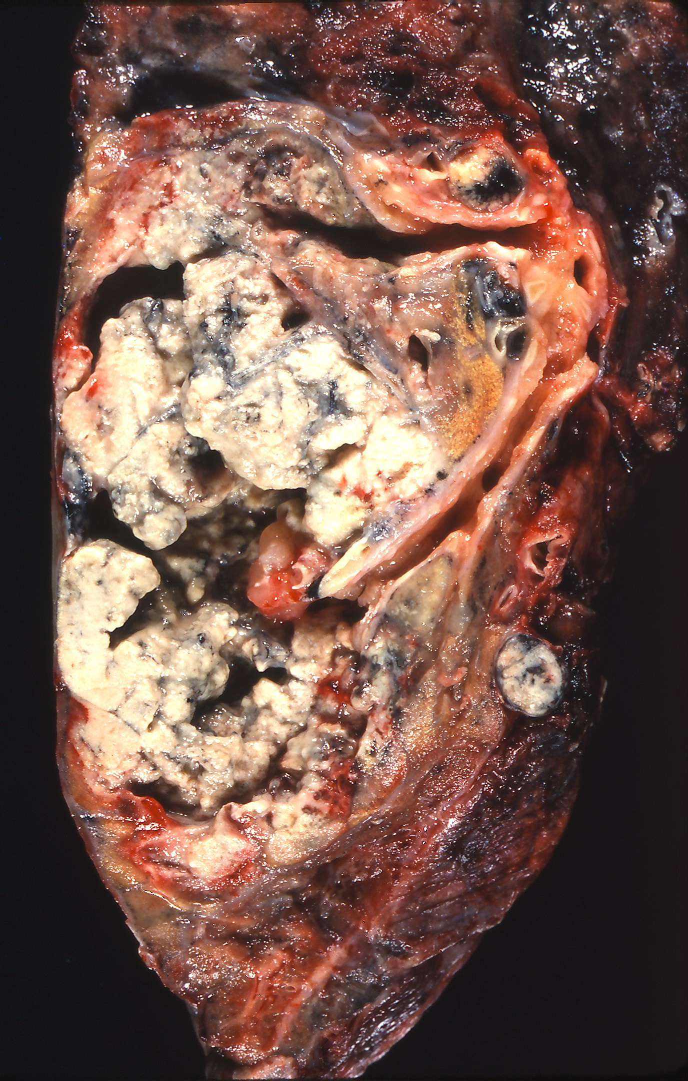 Gross pathology: cavitation, squamous lung cell cancer