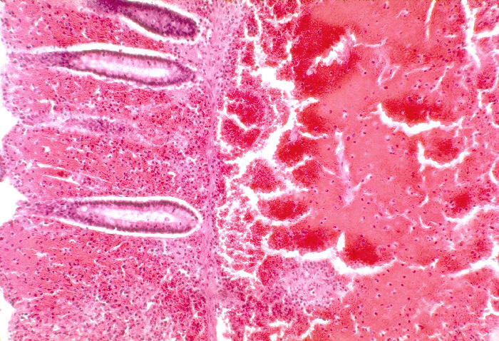 "hematoxylin-eosin (H&E)-stained photomicrograph of a small intestinal tissue sample revealed the presence of histopathologic changes indicative of marked mucosal and submucosal hemorrhage, with accompanying arteriolar degeneration in a case of fatal human anthrax.” Adapted from Public Health Image Library (PHIL), Centers for Disease Control and Prevention.[20]