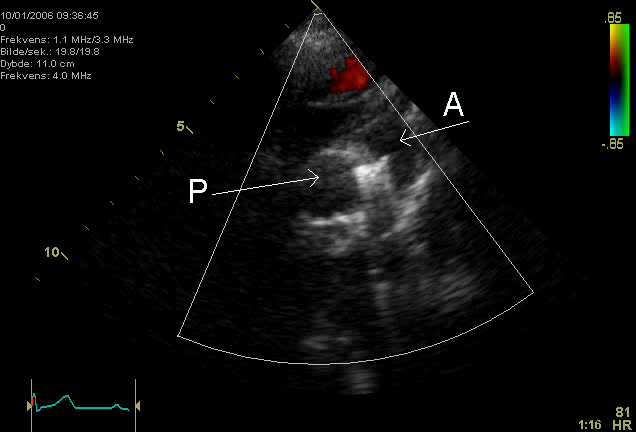 An echocardiogram of a coiled persisting ductus arteriosus. One can see the aortic arch,the pulmonary artery and the coil between them.