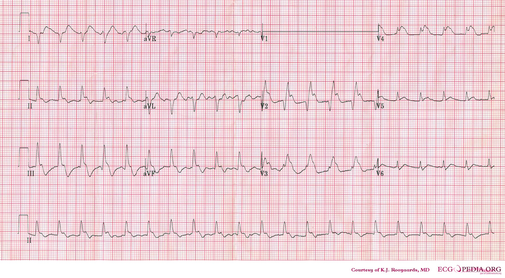 ECG of a patient with pulmonary embolism showing sinus tachycardia and right axis deviation.Image courtesy of ecgpedia