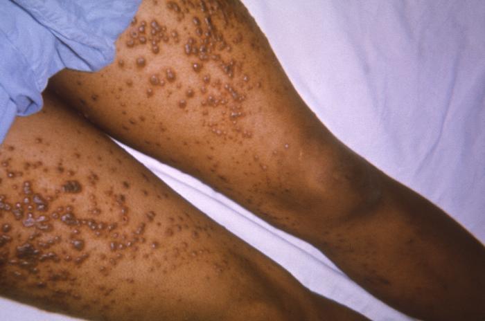 View of a patient’s thighs and upper legs, who’d been diagnosed with chickenpox. From Public Health Image Library (PHIL). [27]