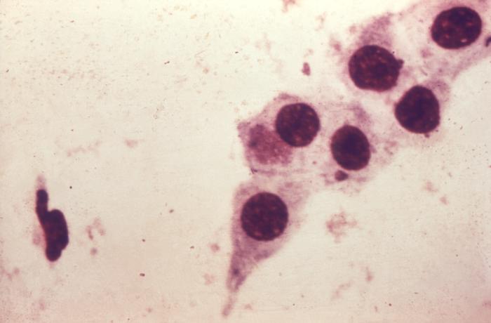 Photomicrograph of Chlamydia trachomatis taken from a urethral scrape. Untreated, chlamydia can cause severe, costly reproductive and other health problems including both short- and long-term consequences, i.e. pelvic inflammatory disease (PID), infertility, and potentially fatal tubal pregnancy. Adapted from CDC
