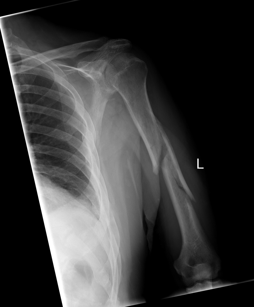File:Comminuted-humeral-shaft-fracture.jpg