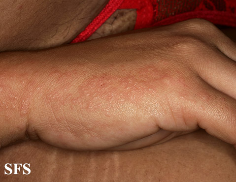 File:Pruritic urticarial papules and plaques of pregnancy10.jpg