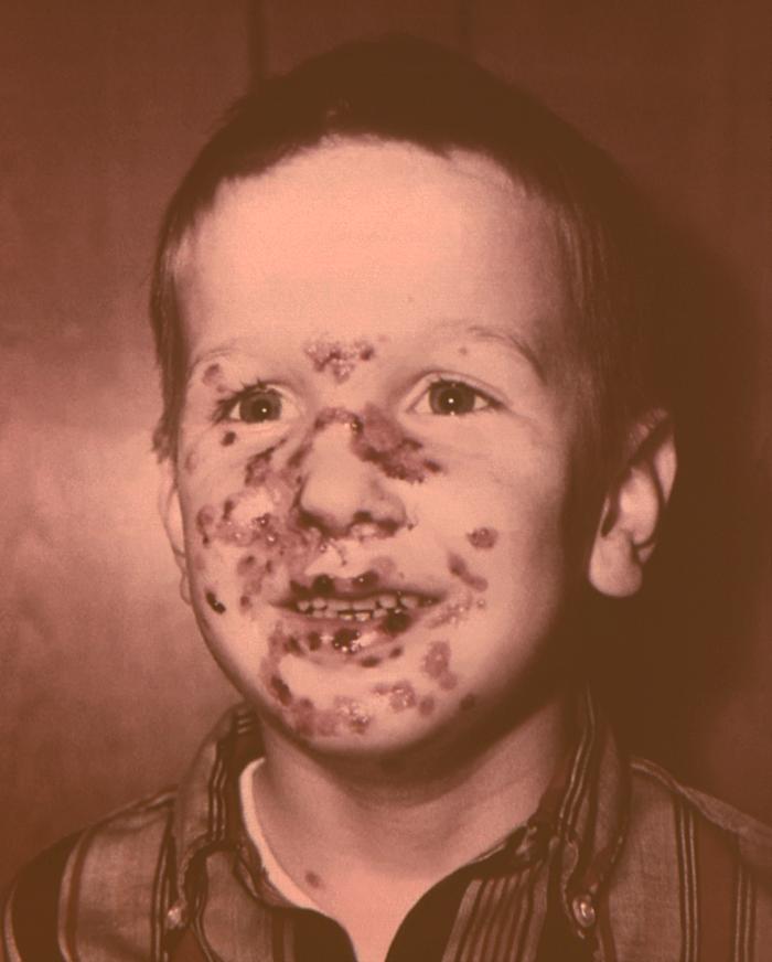 6 year-old boy, who'd been accidentally inoculated with the vaccinia virus, and subsequently developed these vaccinial lesions upon his face. This boy's lesions healed with no residual scarring.