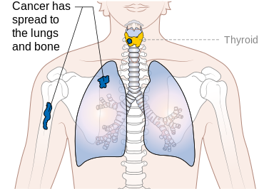 Stage M1 thyroid cancer