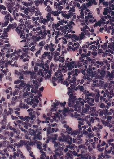 File:Flexner- Wintersteiner Rosettes in Retinoblastoma.jpg